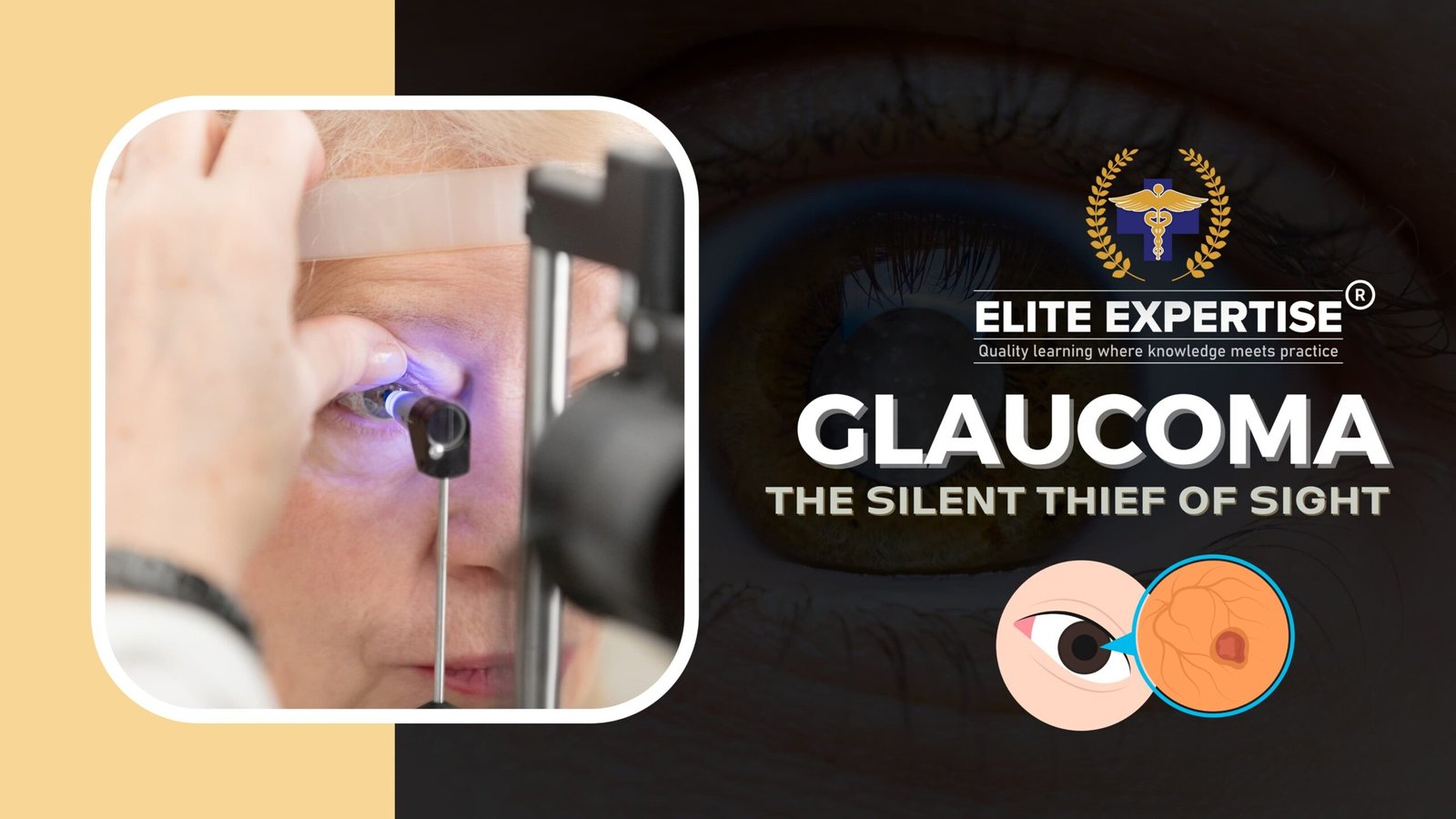 Glaucoma for OPRA Exam